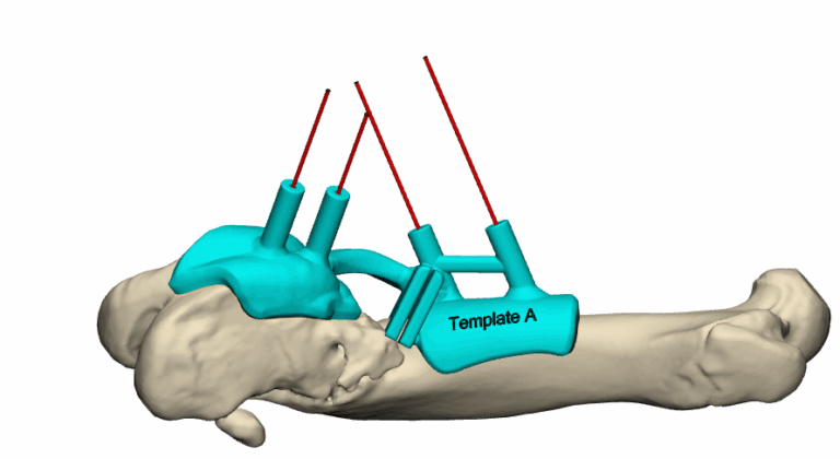 Osteotomie Guide