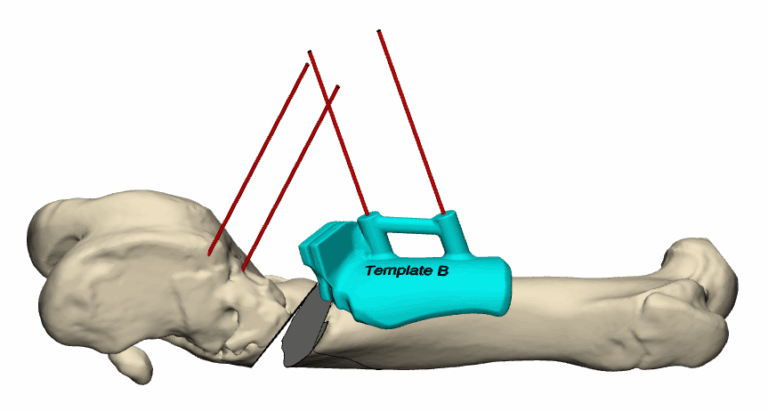 Osteotomie Guide
