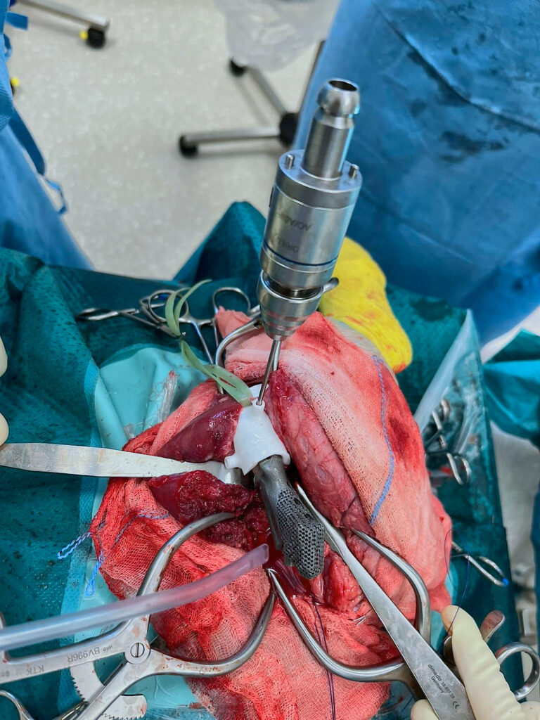 Implantat mit Bohrguide