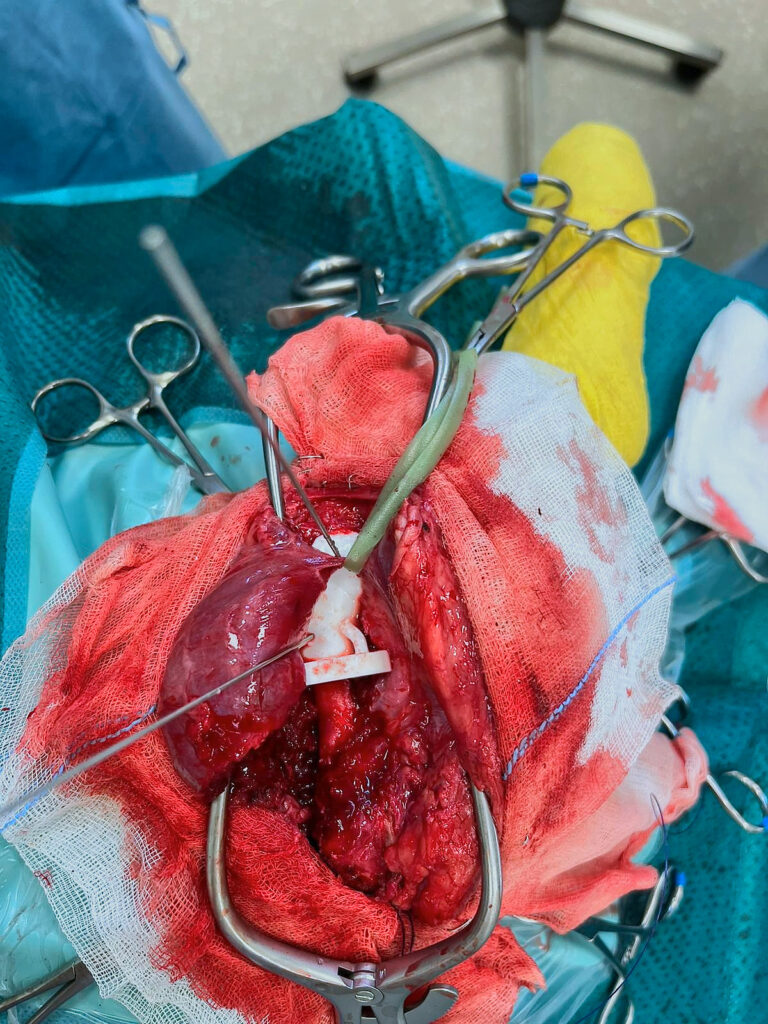 Guide für osteotomie